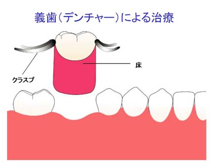 埼玉県鴻巣市・義歯による治療